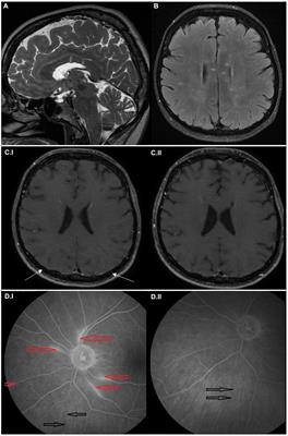 Case report: Susac syndrome—two ends of the spectrum, single center case reports and review of the literature